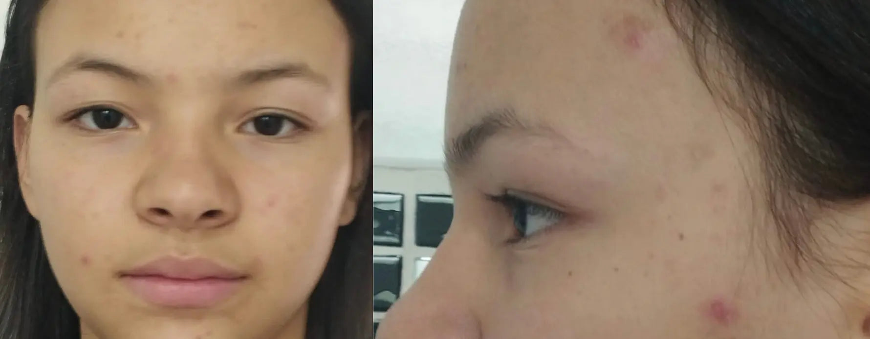 resultados-do-bakuchiol-na-pele - Laboderm Skincare